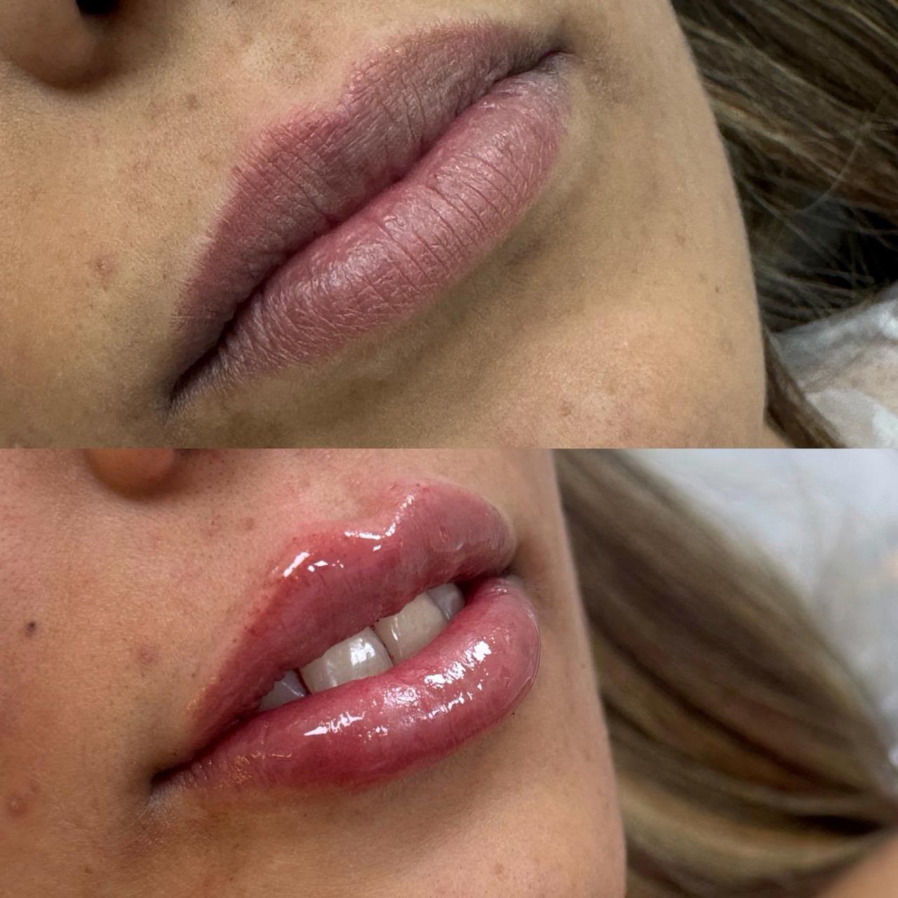Antes e depois de preenchimento labial