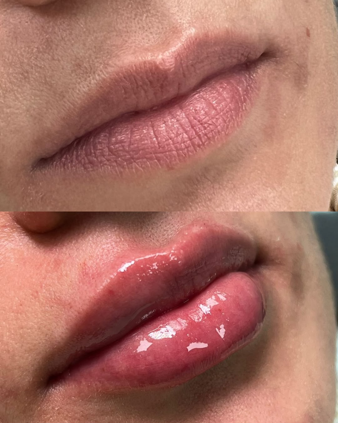 Antes e depois de preenchimento labial