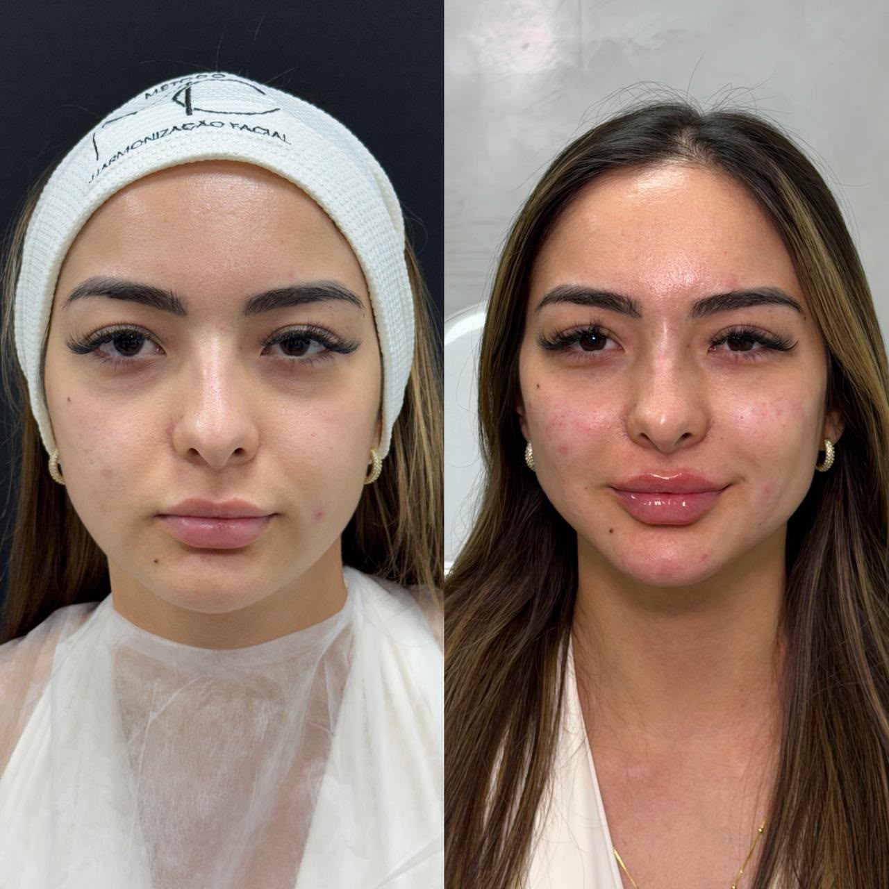 Antes e depois de harmonização facial